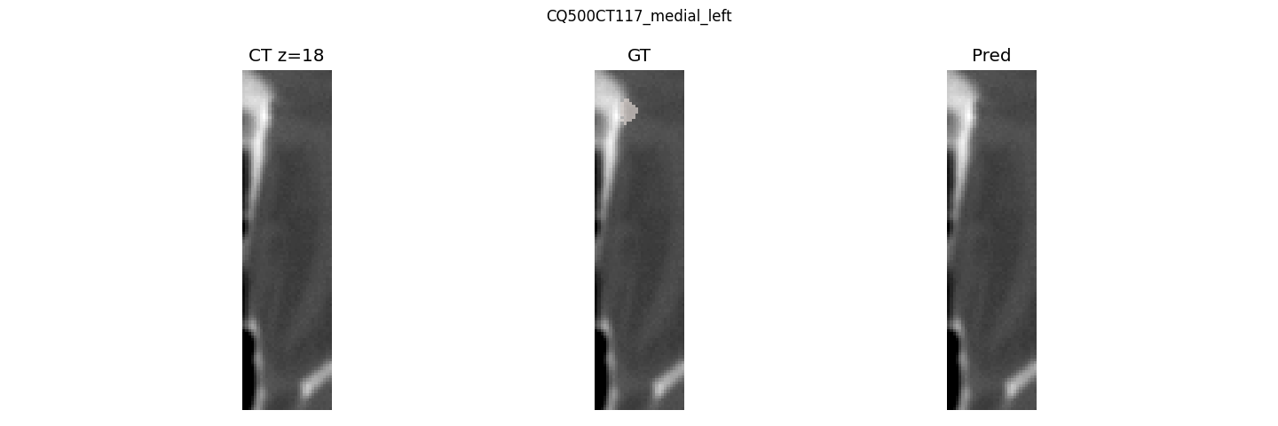 CQ500CT117_medial_left CT, ground truth, prediction overlay